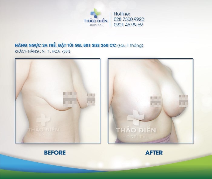 Một vài khách hàng từng nâng ngực túi EuroSilicone tại Bệnh Viện Thảo Điền