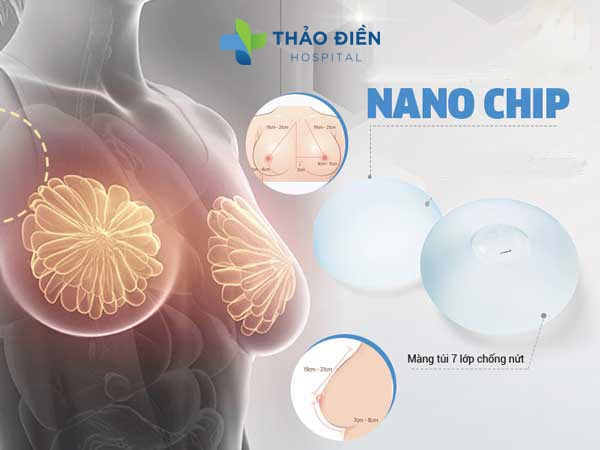 Phẫu thuật nâng ngực nano chip