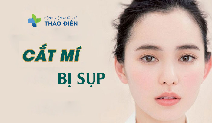 cắt mí mắt bị sụp