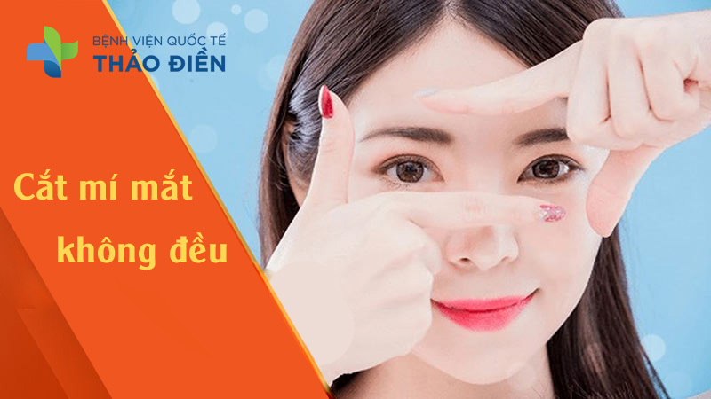 cắt mí mắt không đều